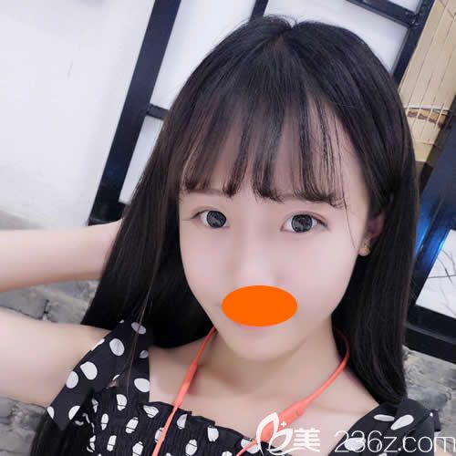 到贛州亞韓整形做prp自體脂肪填充全臉術(shù)后第14天效果 到贛州亞韓整形做prp自體脂肪填充全臉術(shù)后第14天效果