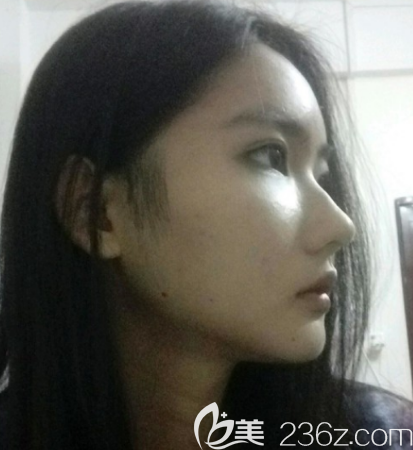 韓國(guó)面部輪廓整形哪家醫(yī)院好？拉菲安真人案例