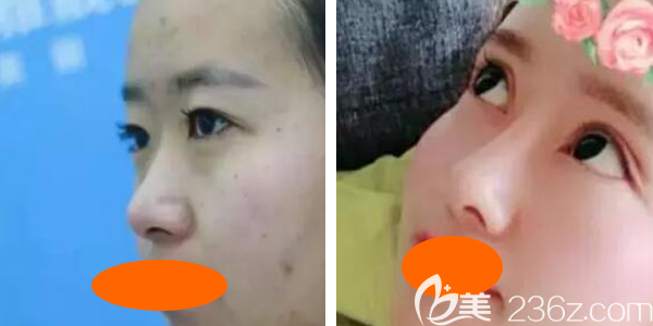 我到西寧時光整形割雙眼皮+假體隆鼻綜合手術(shù)后3個月<span style= 我到西寧時光整形割雙眼皮+假體隆鼻綜合手術(shù)后3個月<span style=