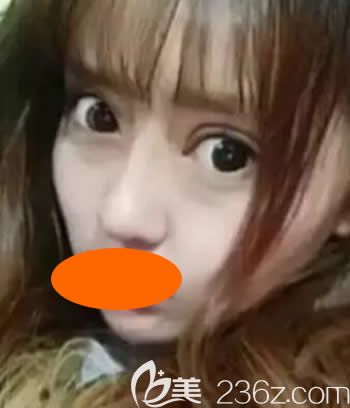 我到西寧時光整形割雙眼皮+假體隆鼻綜合手術(shù)后1個月<span style= 我到西寧時光整形割雙眼皮+假體隆鼻綜合手術(shù)后1個月<span style=