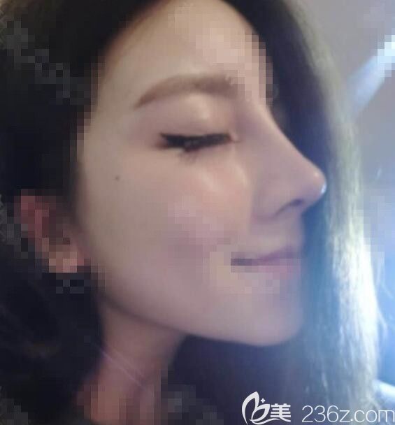 肋骨隆鼻術后8天 肋骨隆鼻術后8天