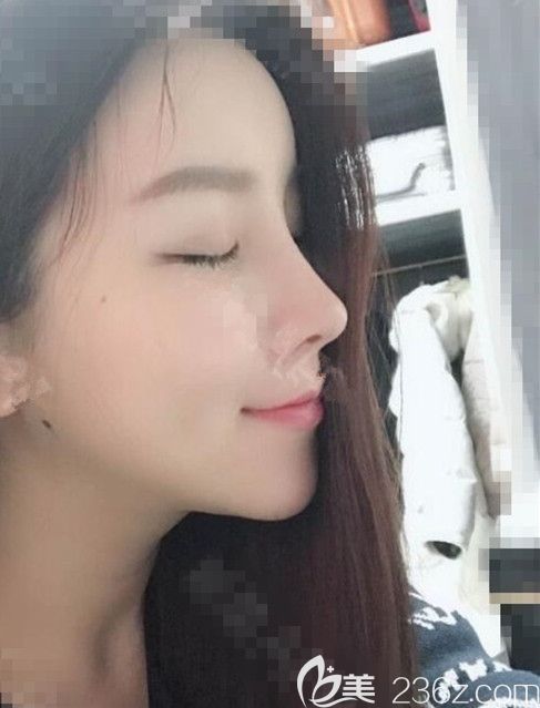 韓國DI整形醫(yī)院李玟榮：半肋骨鼻修復(fù)后原諒我自戀感覺美到炸