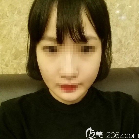 韓國(guó)愛(ài)我整形樸范鎮(zhèn)面部輪廓整形案例