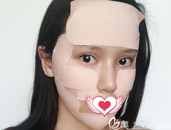 自體脂肪填充法令紋第5天面部的腫脹已經(jīng)消退