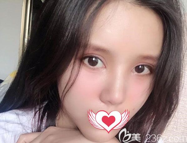 自體脂肪填充第15天淚溝、法令紋都不見了