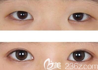 成都<!--<i data=20240703-sp></i>-->雙眼皮術(shù)前術(shù)后對比圖 成都<!--<i data=20240703-sp></i>-->雙眼皮術(shù)前術(shù)后對比圖