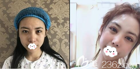 成都<!--<i data=20240703-sp></i>-->雙眼皮修復(fù)案例效果圖 成都<!--<i data=20240703-sp></i>-->雙眼皮修復(fù)案例效果圖