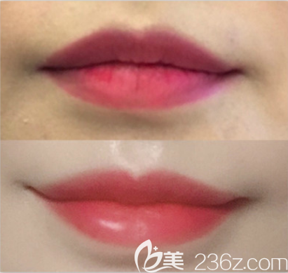 豐唇前后對比效果圖 豐唇前后對比效果圖