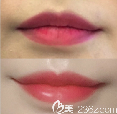 韓國非手術微笑唇前后對比照 韓國非手術微笑唇前后對比照