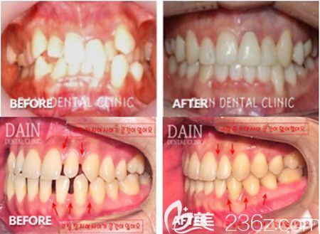 韓國多仁牙科對比案例