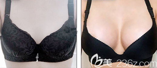 韓國(guó)City7整形醫(yī)院假體隆胸案例 韓國(guó)City7整形醫(yī)院假體隆胸案例