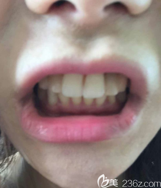 瓷貼面術(shù)前 瓷貼面術(shù)前