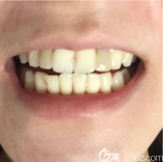 術(shù)前 術(shù)前