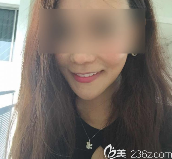 瓷貼面術(shù)后 瓷貼面術(shù)后