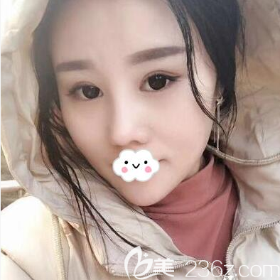 我要是早早在成都銅雀臺(tái)找劉祎做了肋軟骨鼻綜合手術(shù)，就不去嘗試那種隆鼻神器了，沒(méi)用不說(shuō)還很疼