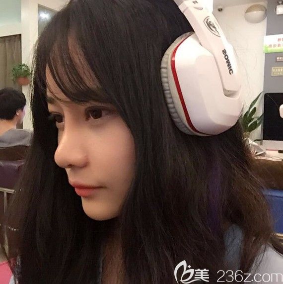 韓國自然主義整形怎么樣？眼鼻案例真實見證