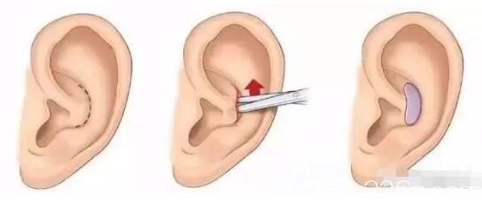 耳軟骨隆鼻取骨位置
