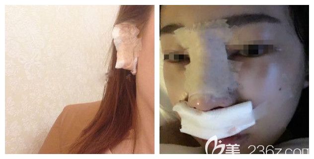 剛做完自體耳軟骨鼻綜合術后即刻效果