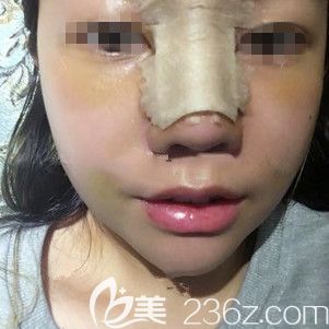 術后三天鼻綜合恢復效果