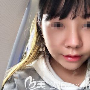 自體耳軟骨+硅膠隆鼻術后半個月效果