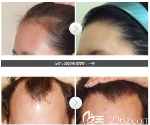 東莞美立方任陽海醫(yī)生發(fā)際線植發(fā)案例