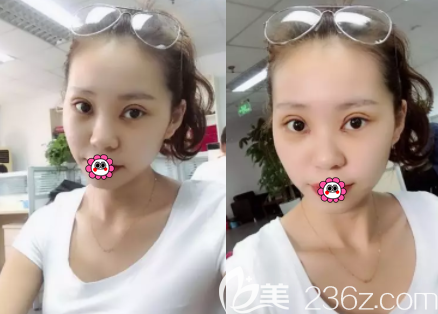 北京藝星美杜莎美眼術(shù)案例 北京藝星美杜莎美眼術(shù)案例