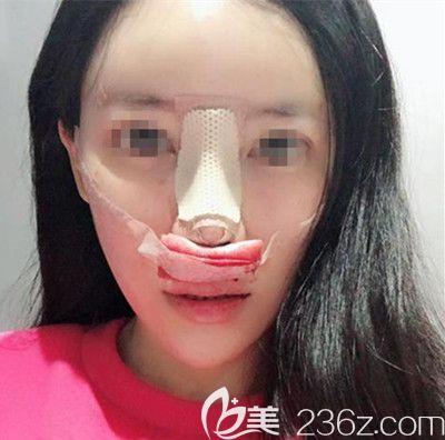 在韓國(guó)寶士麗做自體脂肪填充+鼻綜合手術(shù)當(dāng)天