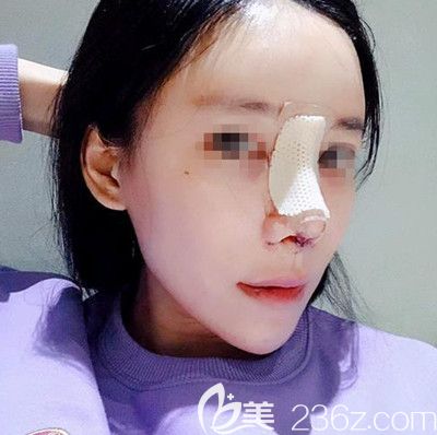 在韓國(guó)寶士麗做自體脂肪填充+鼻綜合手術(shù)后3天