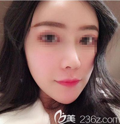 在韓國(guó)寶士麗做自體脂肪填充+鼻綜合手術(shù)后2周