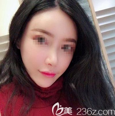 在韓國(guó)寶士麗做自體脂肪填充+鼻綜合手術(shù)后1個(gè)月