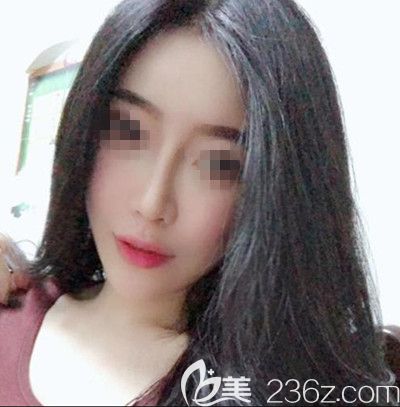 在韓國(guó)寶士麗做自體脂肪填充+鼻綜合手術(shù)后2個(gè)月