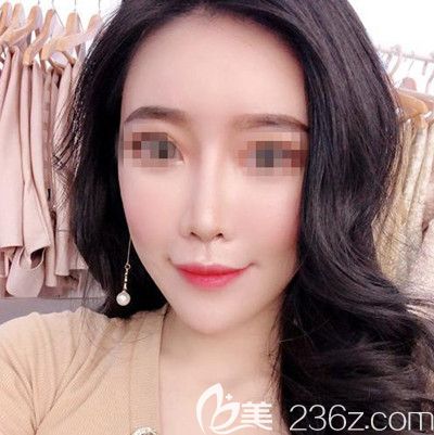 找韓國(guó)寶士麗金基范院長(zhǎng)做了鼻綜合+自體脂肪填充后半年的恢復(fù)過程