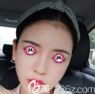 我是3月在淄博美冠臣做了面部吸脂手術(shù)，姐妹們可以參考一下哦