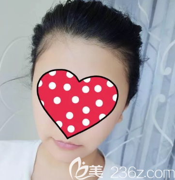 面部吸脂一個月之后的樣子 面部吸脂一個月之后的樣子