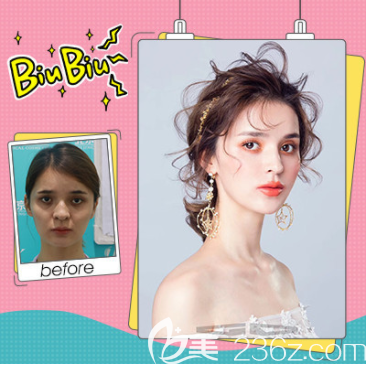 北京壹加壹張綠峰膨體隆鼻+自體耳軟骨隆鼻案例