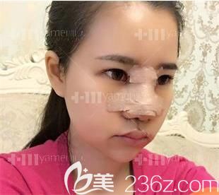 隆鼻后第二階段淤血階段