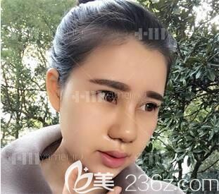 假體隆鼻后第三階段鼻背壓痛階段