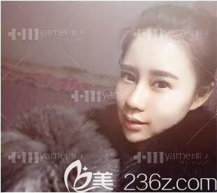 做完鼻整形后恢復階段