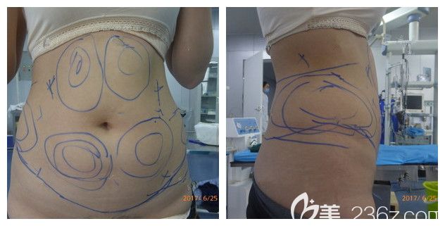 術(shù)前腰腹部贅肉明顯 術(shù)前腰腹部贅肉明顯