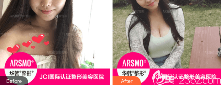 北京華韓假體隆胸前后對(duì)比圖