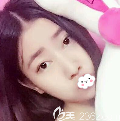 玻尿酸除皺能維持多久？我在成都銅雀臺(tái)找雷國(guó)婕做玻尿酸填充法令紋的親身經(jīng)歷