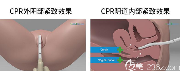 陰道緊縮前后效果對(duì)比圖片