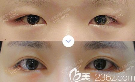 韓國艾恩雙眼皮+開眼角案例 韓國艾恩雙眼皮+開眼角案例