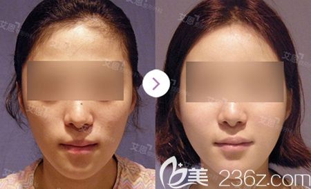 韓國艾恩全臉脂肪填充案例 韓國艾恩全臉脂肪填充案例