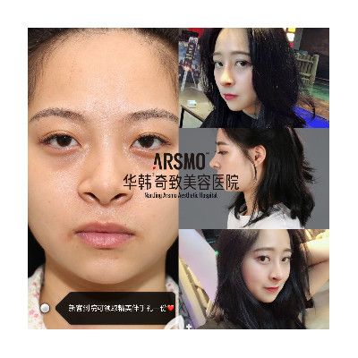 錢成寶眼部整形案例 錢成寶眼部整形案例