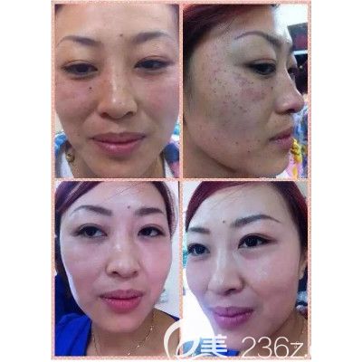 張金俠激光祛斑案例 張金俠激光祛斑案例