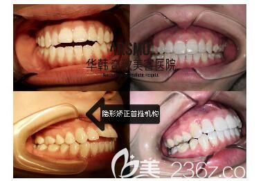 王博牙齒矯正+美白案例 王博牙齒矯正+美白案例