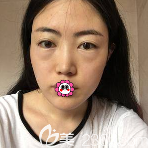 在北京畫美做內(nèi)切法祛眼袋前樣子 在北京畫美做內(nèi)切法祛眼袋前樣子