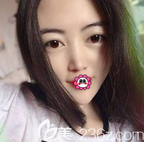 在北京畫美做內(nèi)切法祛眼袋第15天<span style= 在北京畫美做內(nèi)切法祛眼袋第15天<span style=