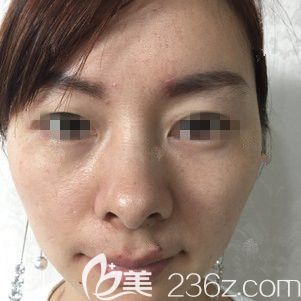 面診徐州時光洪揚術前老態(tài)明顯 面診徐州時光洪揚術前老態(tài)明顯